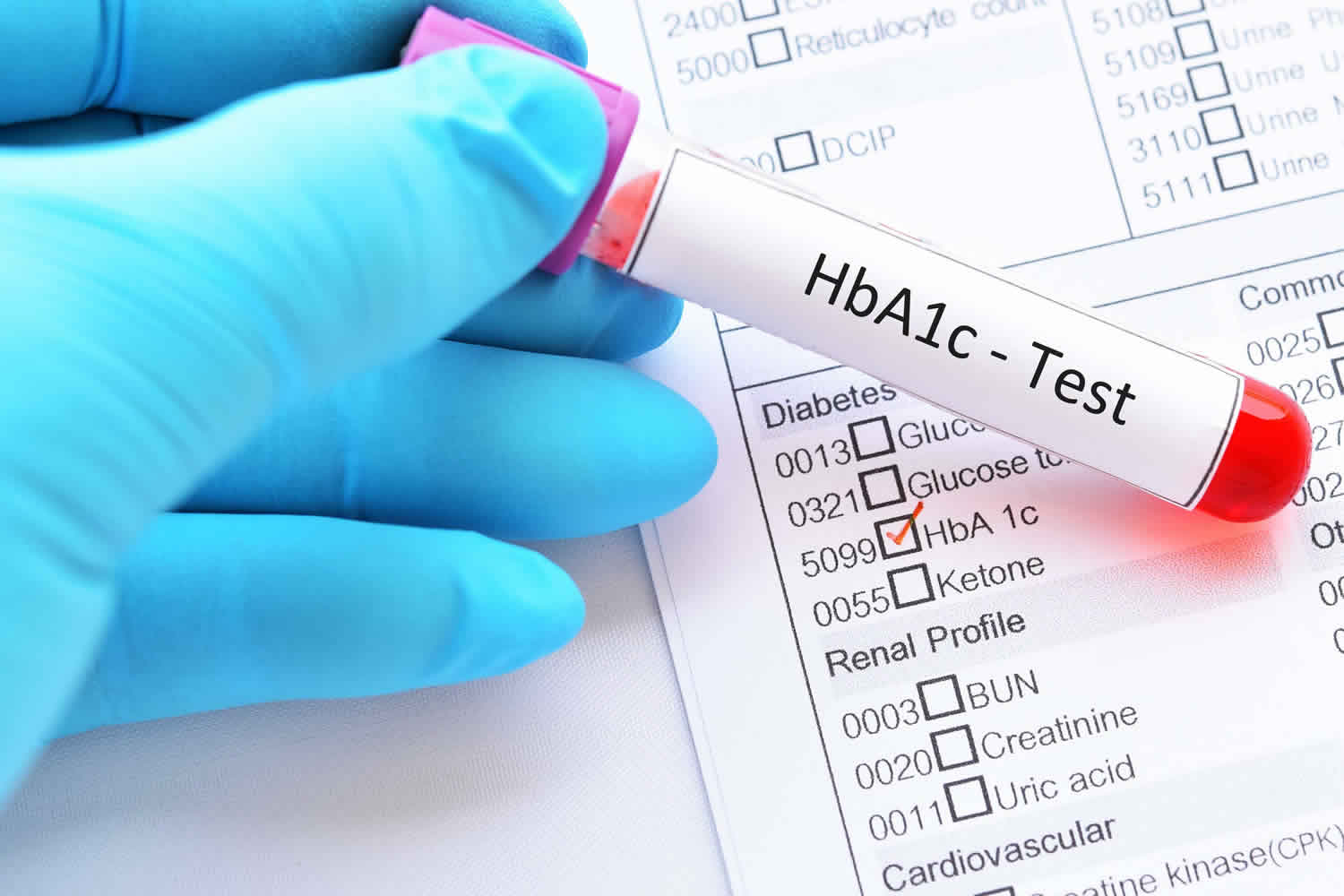 تشخیص دیابت نوع دو با آزمایش هموگلوبین گلیکوزیله